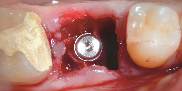 Open Barrier Membrane Technique